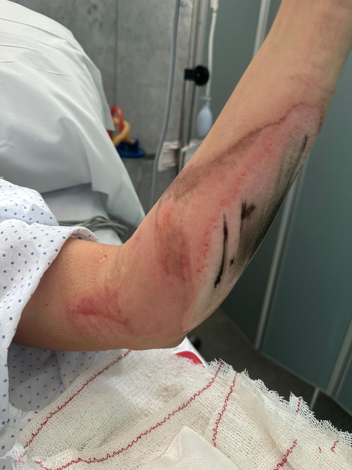 Habla la víctima del primer atropello en Cornellà: “Mi brazo quedó atrapado entre la rueda y la acera” 1 victima primer atropello 1