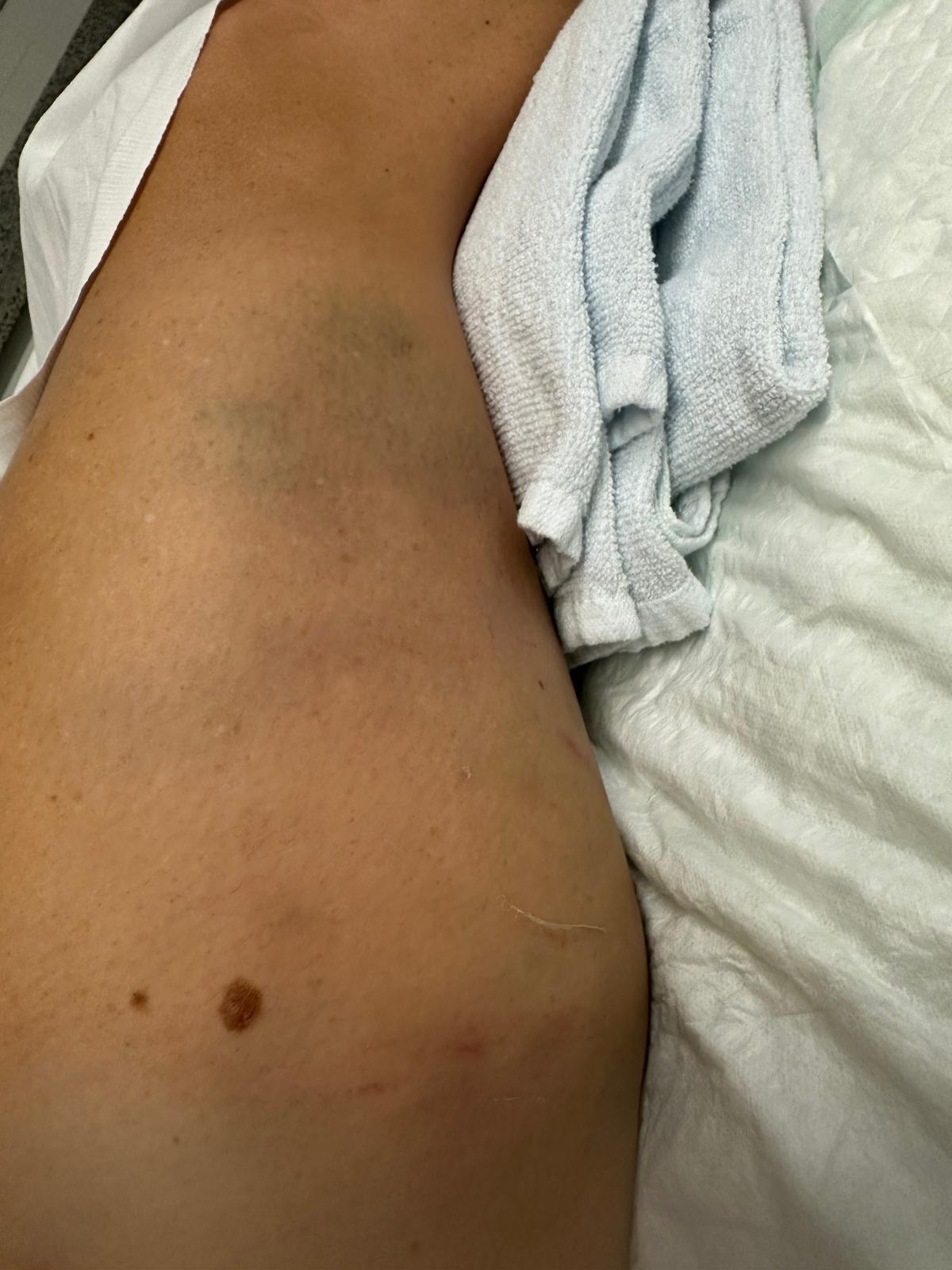 Habla la víctima del primer atropello en Cornellà: “Mi brazo quedó atrapado entre la rueda y la acera” 3 victima primer atropello 3