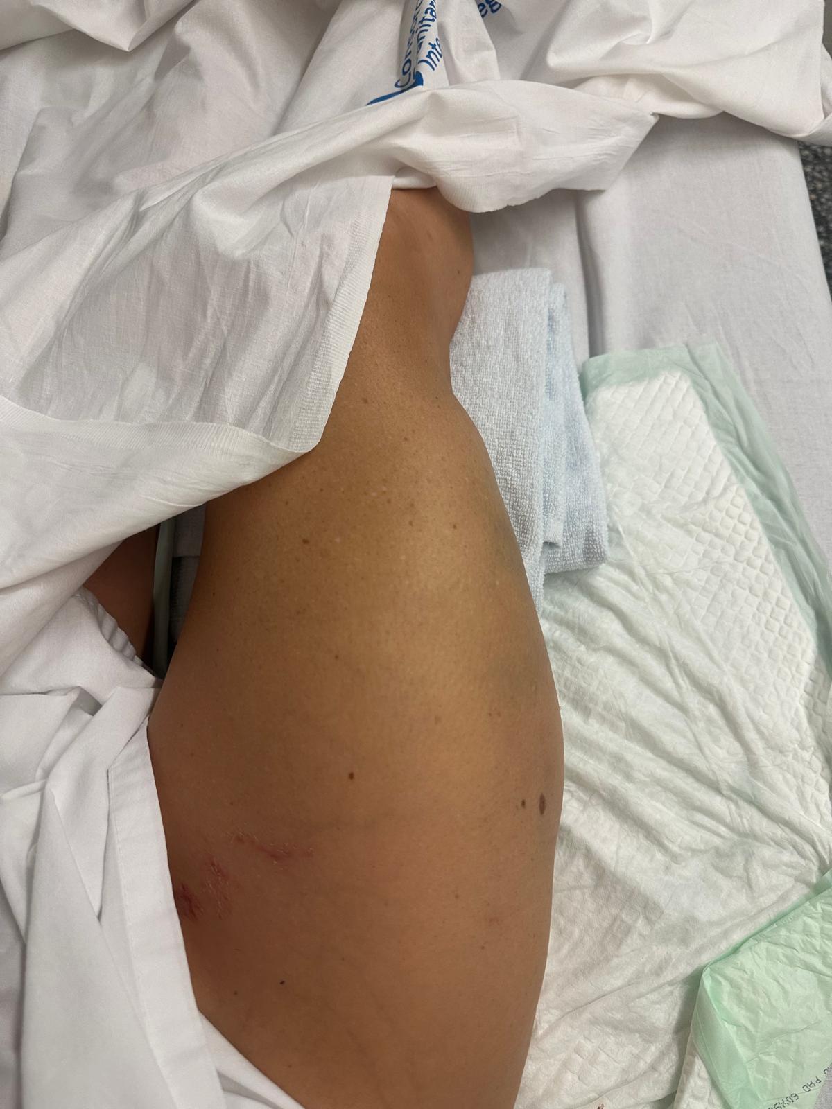 Habla la víctima del primer atropello en Cornellà: “Mi brazo quedó atrapado entre la rueda y la acera” 4 victima primer atropello 4