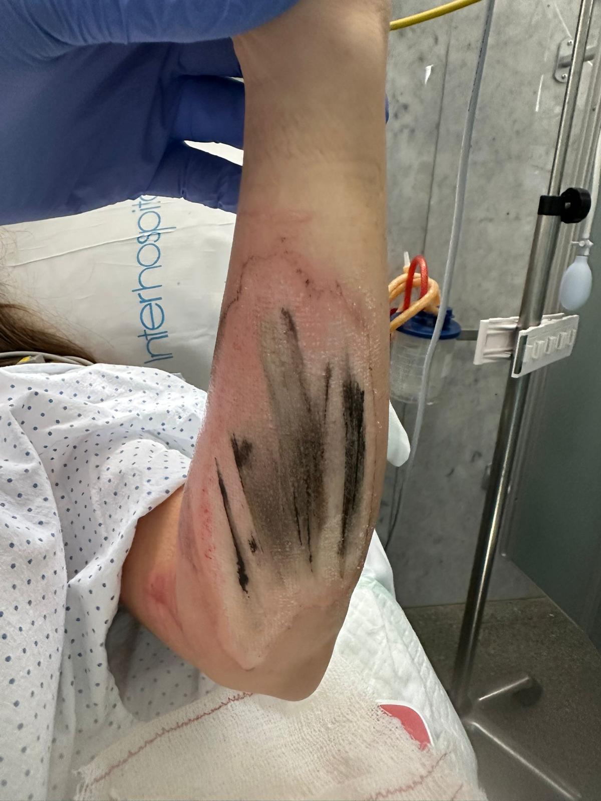 Habla la víctima del primer atropello en Cornellà: “Mi brazo quedó atrapado entre la rueda y la acera” 2 victima primer atropello 5